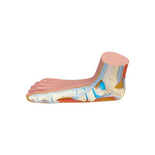 3B Anatomical Model - Flat Foot (Pes Panus)